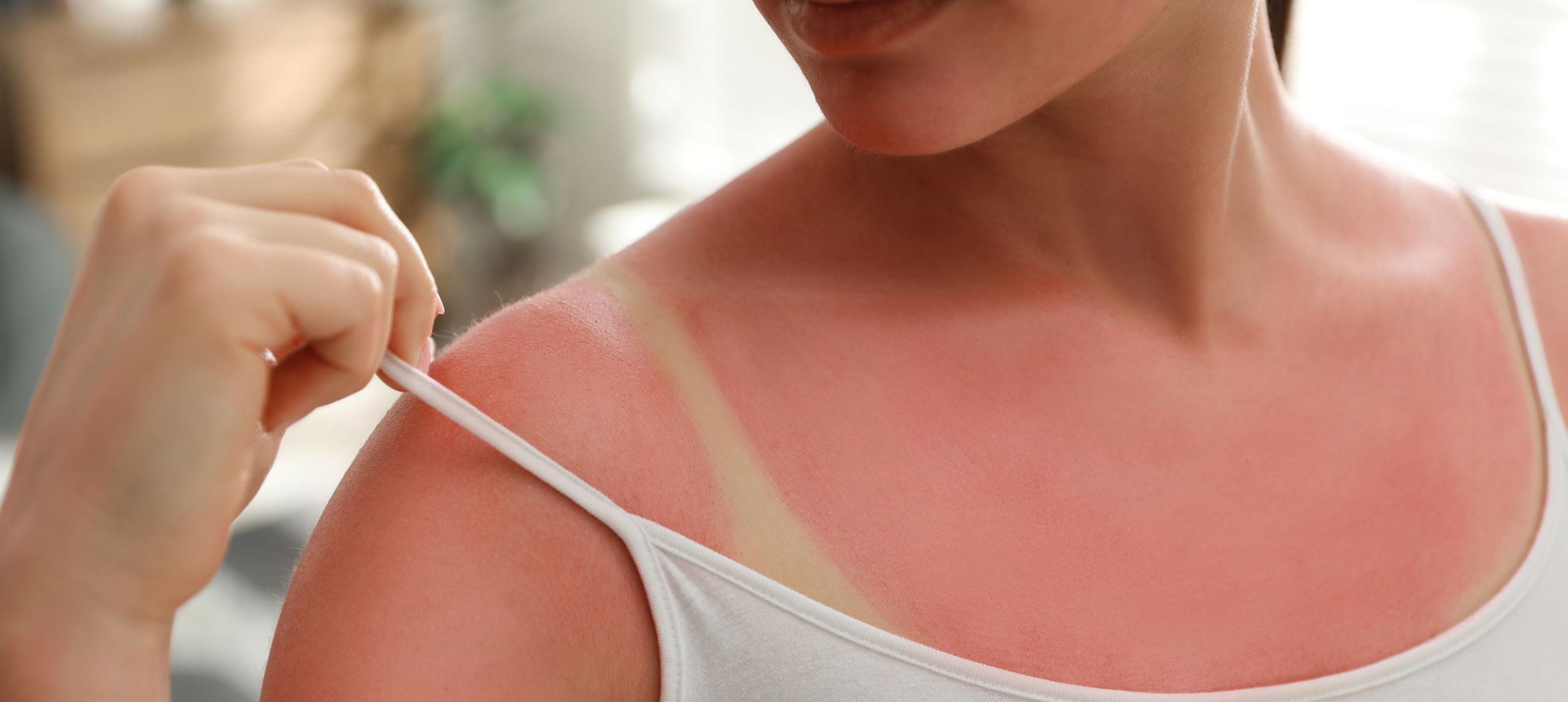 Et si on arrêtait de sous-estimer l’impact du soleil sur notre peau ?